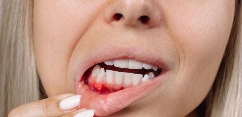 Pus near the gumline